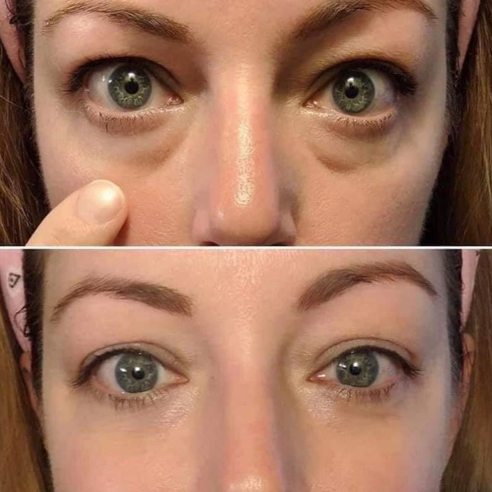 Eyes Bags Cream Removal